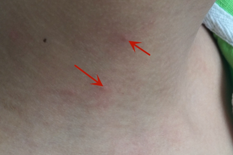 水痘脖子右侧有皮疹图