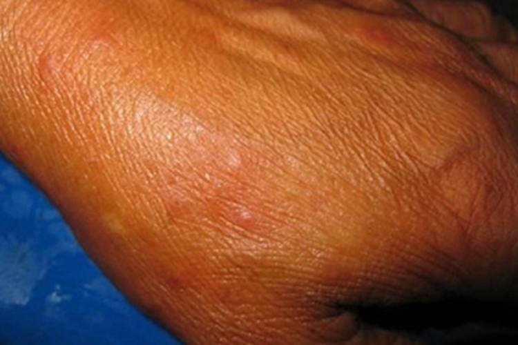 动物血吸虫尾蚴皮炎手背丘疹图