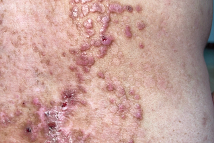 大疱性表皮松解症小疙瘩图 大疱性表皮松解症小疙瘩图