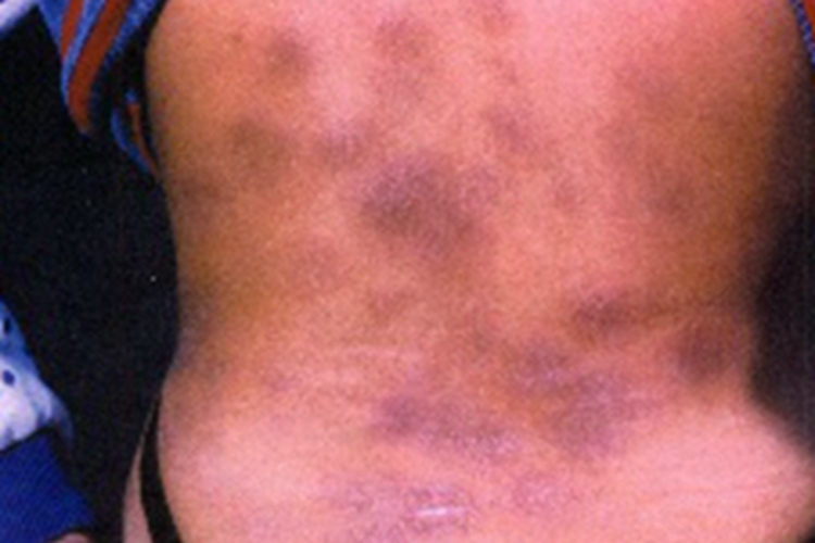 皮肤白血病背部紫斑图