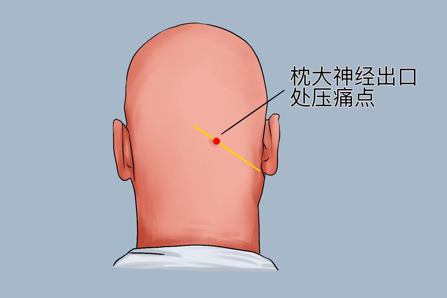 枕大神经出口处压痛点图