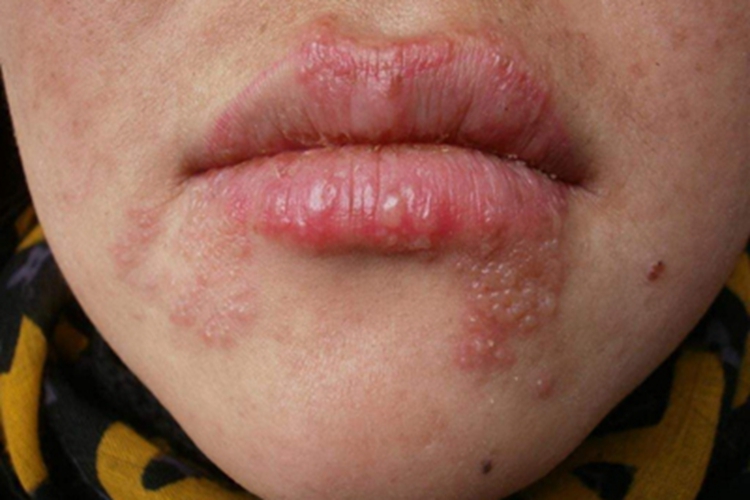 口唇疱疹口周大面积水疱图
