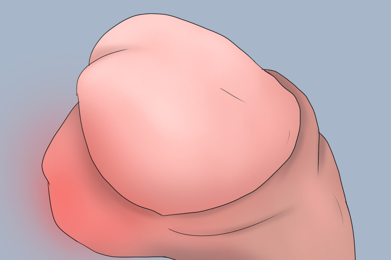 系带水肿图 系带水肿图