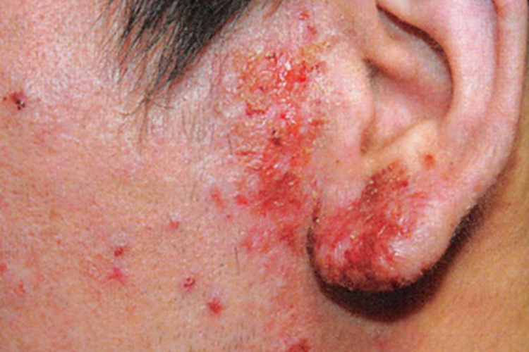 湿疹耳前渗液图 湿疹耳前渗液图