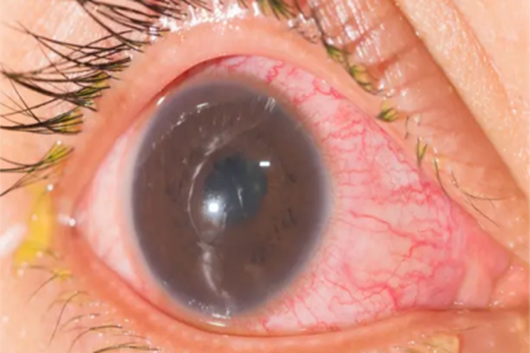 化脓性葡萄膜炎化脓图 化脓性葡萄膜炎化脓图