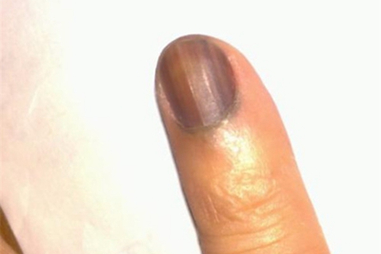 肢端雀斑痣样黑素瘤手指甲发黑图