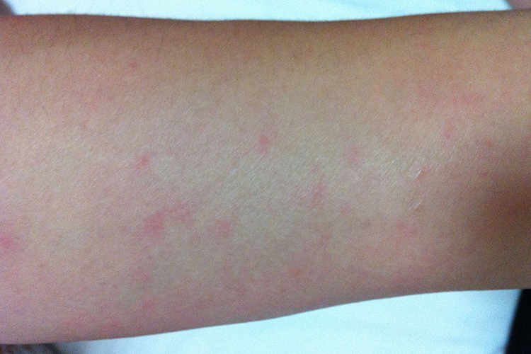 暴露部位红斑图 暴露部位红斑图