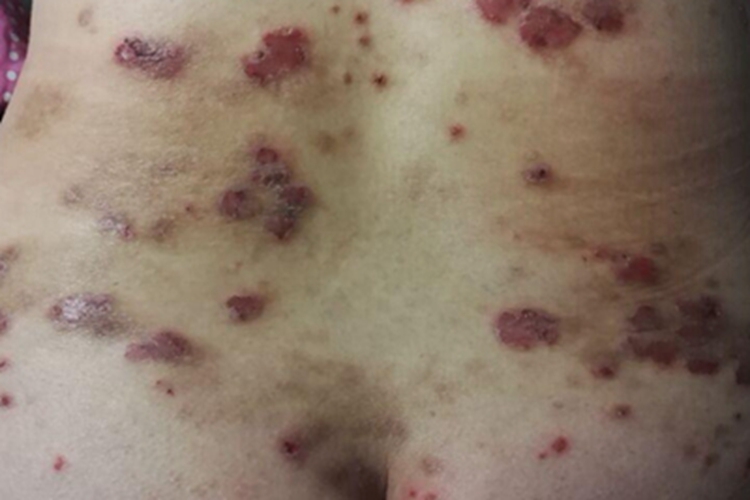 瘙痒症出现糜烂图 瘙痒症出现糜烂图