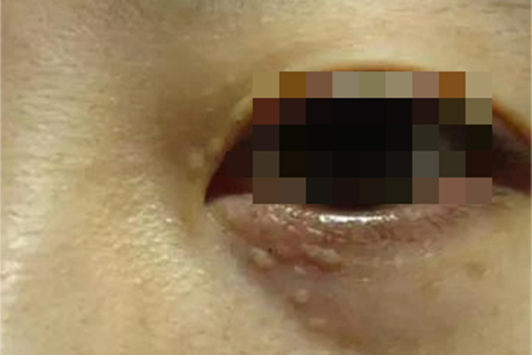 汗腺瘤眼睑丘疹图 汗腺瘤眼睑丘疹图