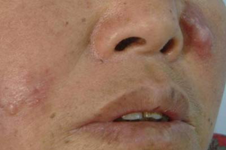 早期寻常狼疮图