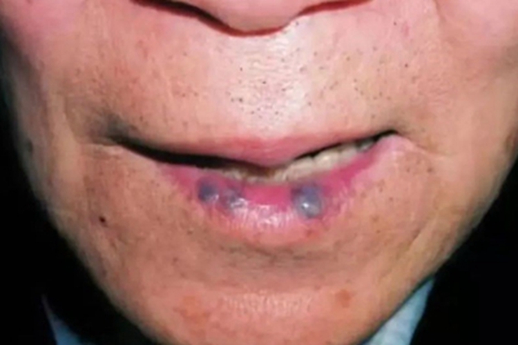 静脉湖嘴唇症状图