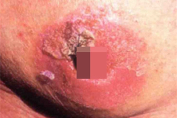 乳房Paget病乳晕红肿图 乳房Paget病乳晕红肿图