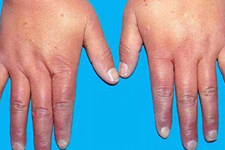 混合性结缔组织病手指肿胀图