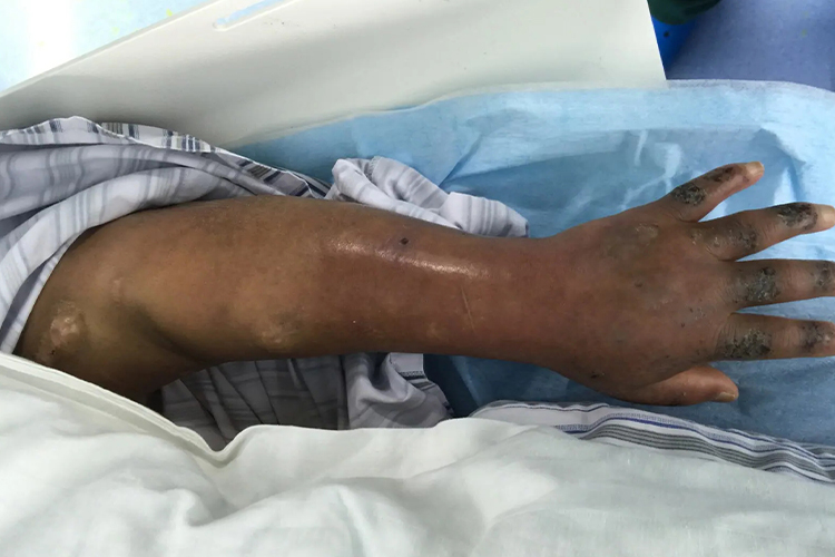 静脉血栓形成手臂肿胀图