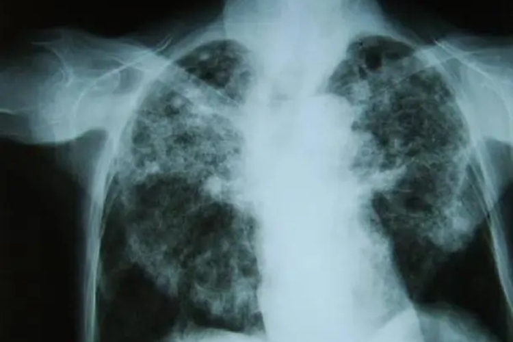 尘肺病X线图