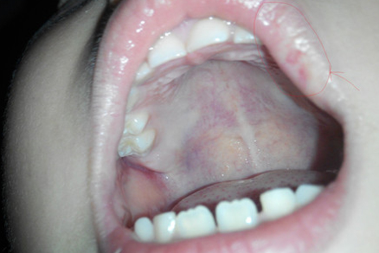 嘴唇内侧长了个血管瘤图片