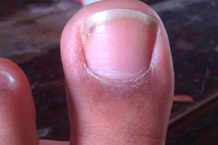 慢性甲沟炎大脚趾发红发肿图