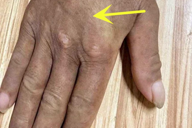 炎症后色素沉着手背斑图