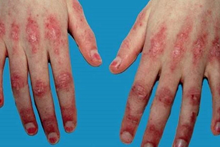血管萎缩性皮肤异色病手部红斑图 血管萎缩性皮肤异色病手部红斑图