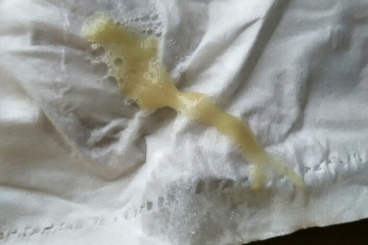 急性支气管炎咳出小坨凝固的痰图