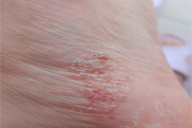 足癣脚部结痂图