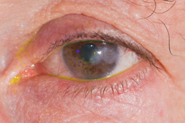 单纯疱疹性角膜炎眼睑红肿图 单纯疱疹性角膜炎眼睑红肿图