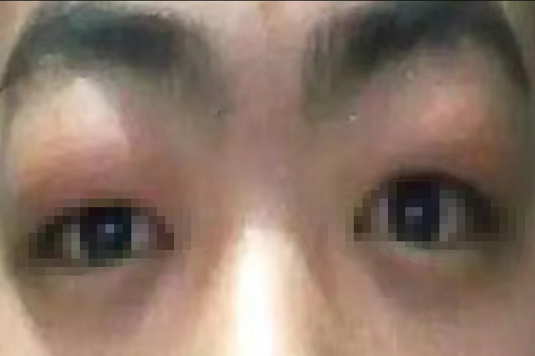 贫血眼睑水肿图 贫血眼睑水肿图