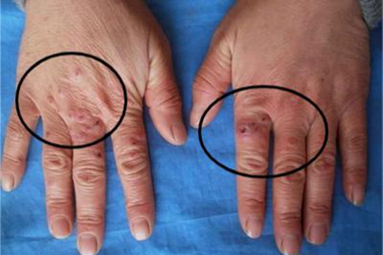 寒冷性多形红斑手背长斑图