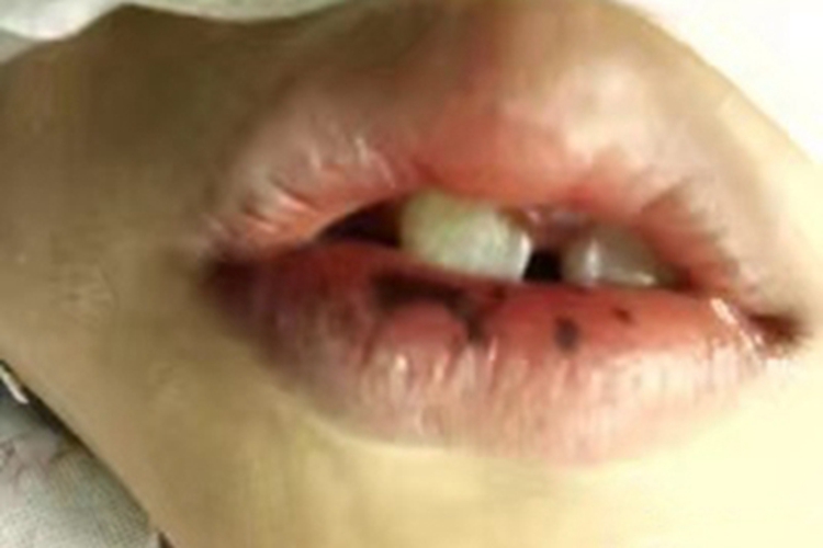 色素沉着息肉综合征嘴唇有黑斑图