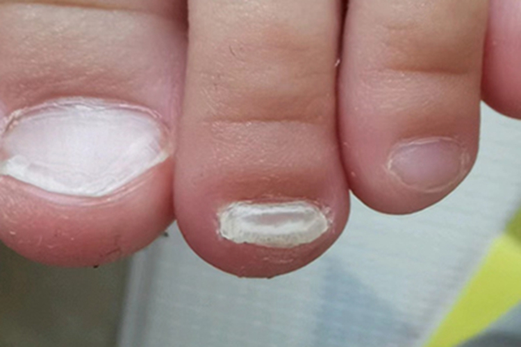 白甲脚趾甲症状图 白甲脚趾甲症状图
