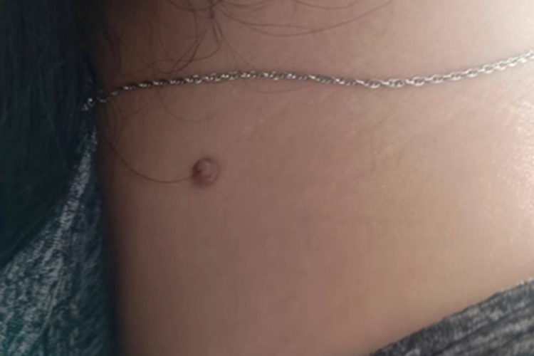 皮内痣颈部症状图