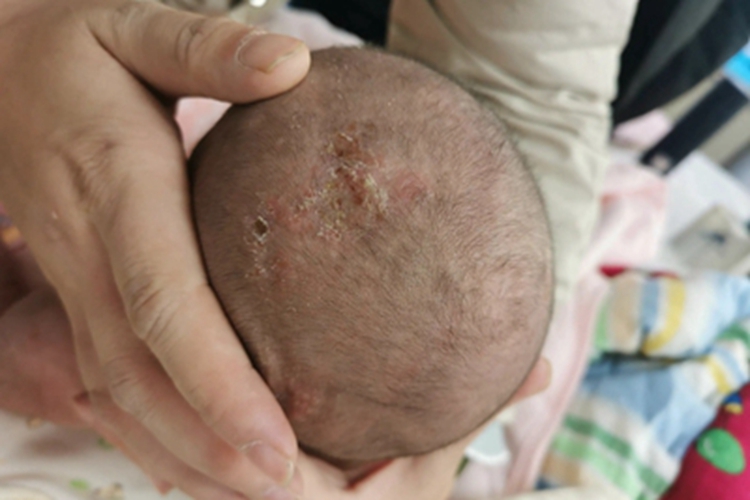 新生儿脓疱疮头皮结痂脱屑图