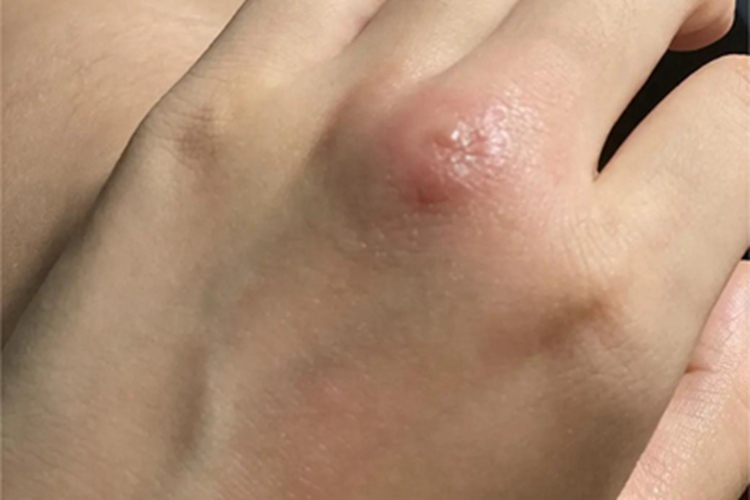 虫咬皮炎手背风团图