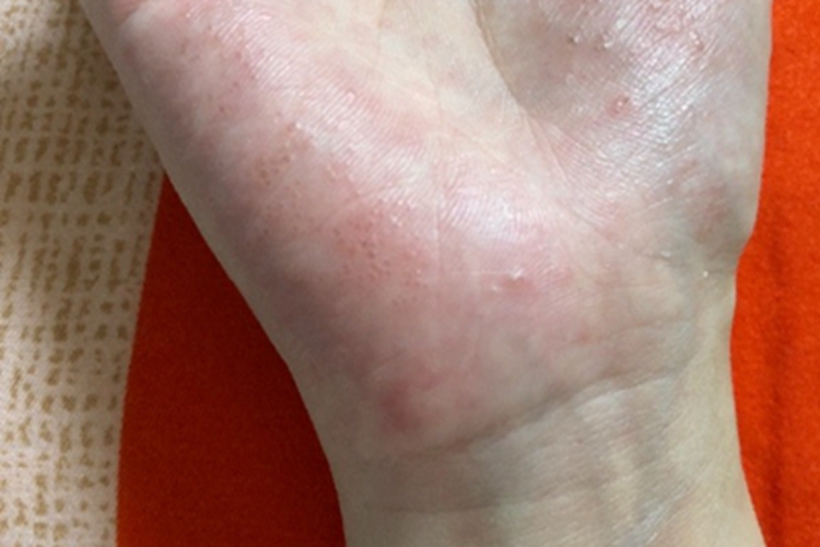 手部湿疹症状图 手部湿疹症状图