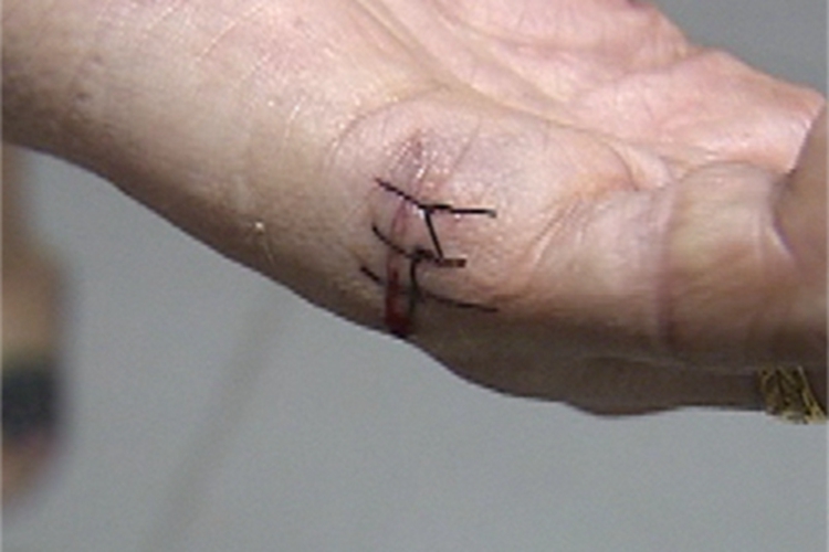 割伤手掌侧面口子缝线图