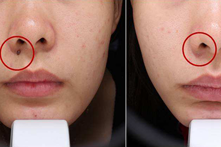 鼻子激光祛痣效果图