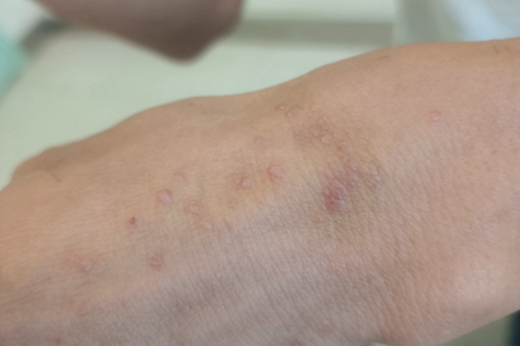 扁平疣手背丘疹图