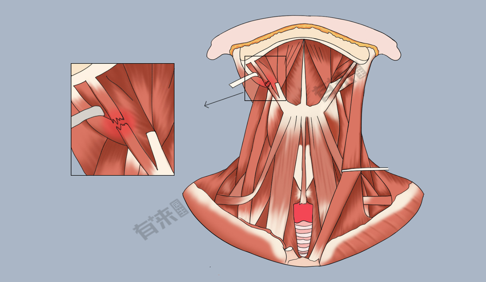 胸骨舌骨肌综合征图片