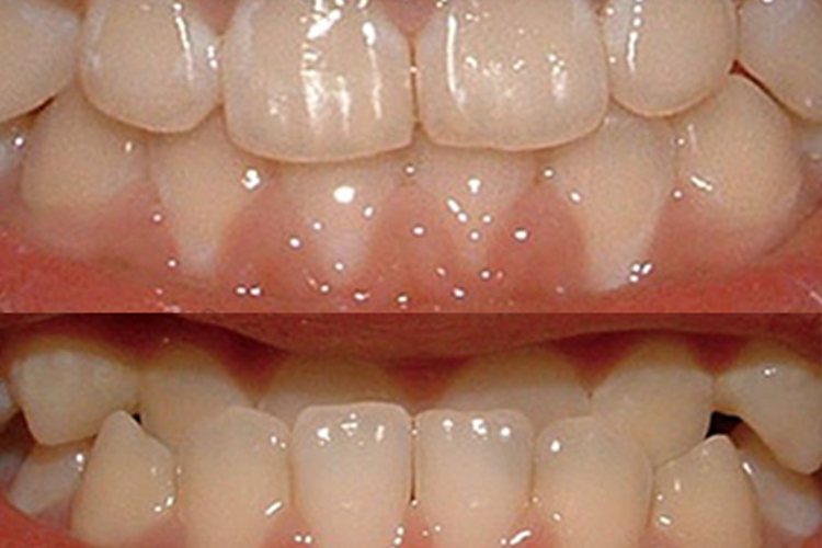 地包天矫正前后对比图 地包天矫正前后对比图