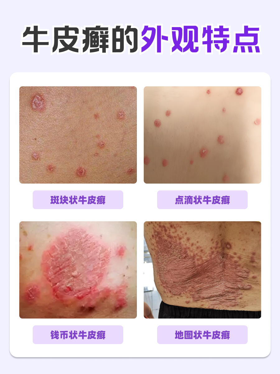 牛皮癣的特点？皮肤科医生带你全面了解！