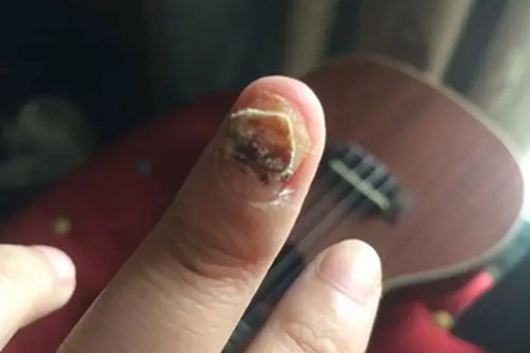 甲营养不良手指甲缺损图