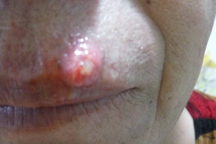 嘴唇长火疖子图