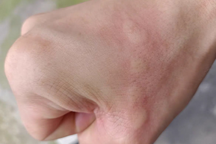 荨麻疹手背大疙瘩图