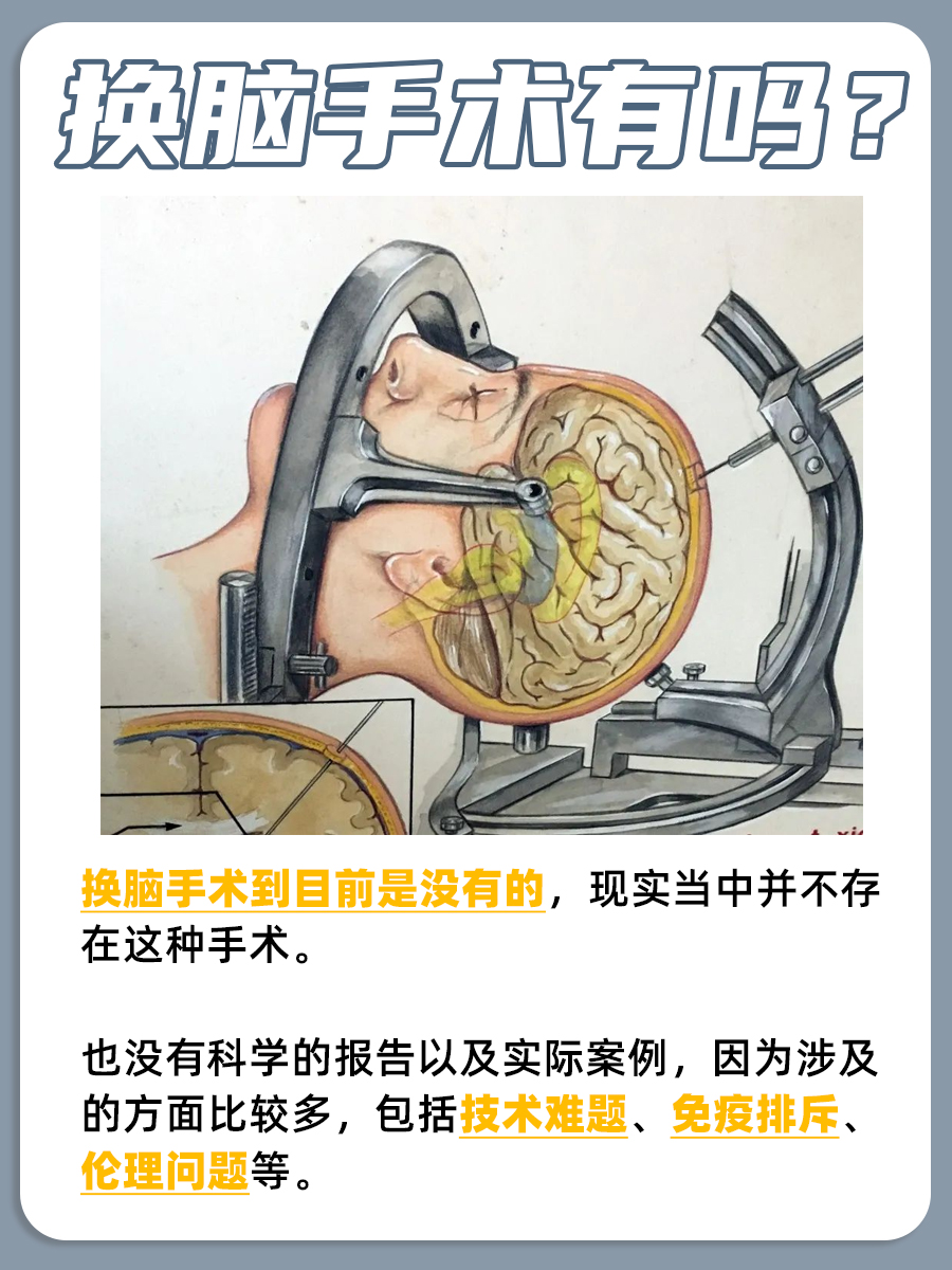 换脑手术成真？科幻还是现实？