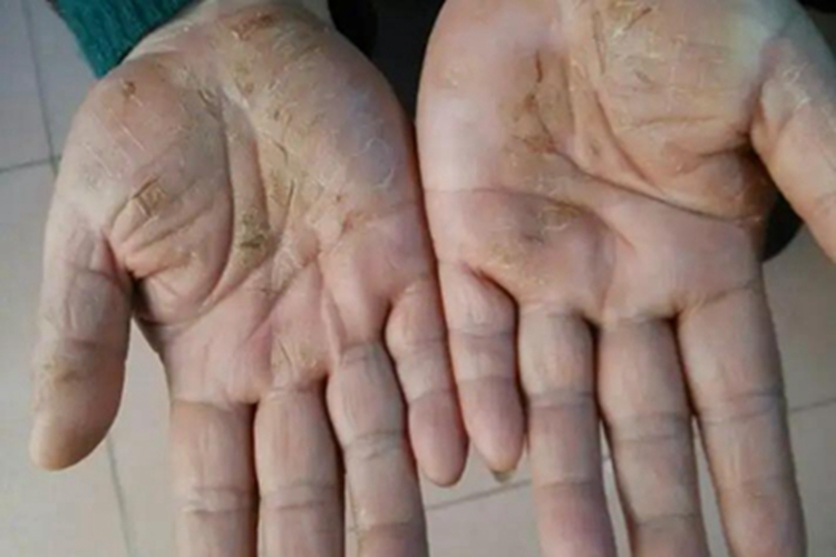 获得性掌跖角化病手掌裂口图 获得性掌跖角化病手掌裂口图