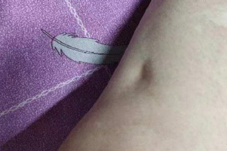 胳膊局限型皮下脂肪萎缩图 胳膊局限型皮下脂肪萎缩图