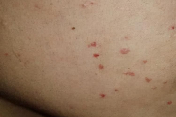 HPV初期身上红疹子图 HPV初期身上红疹子图