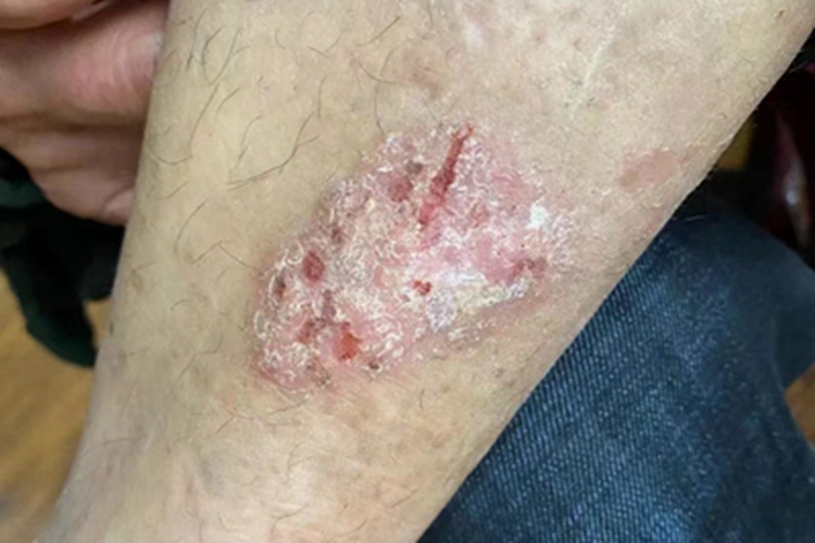慢性湿疹小腿糜烂图