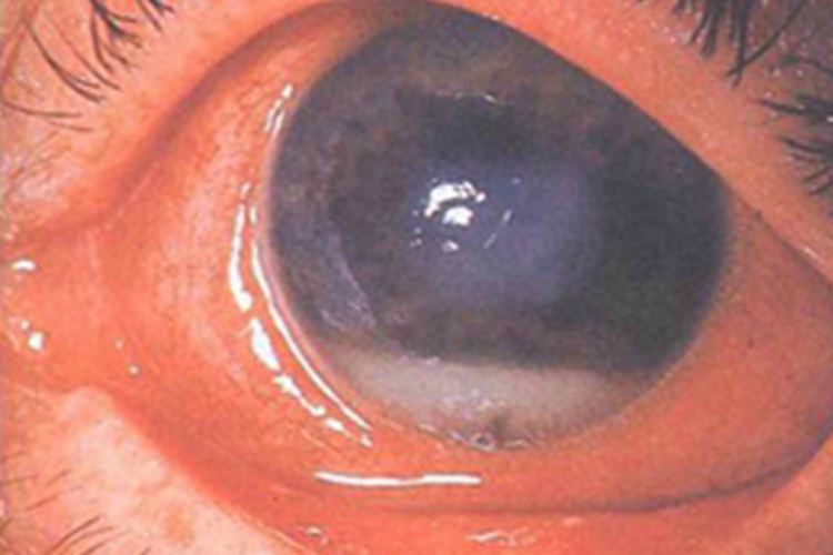 基质性角膜炎角膜有个蓝斑图