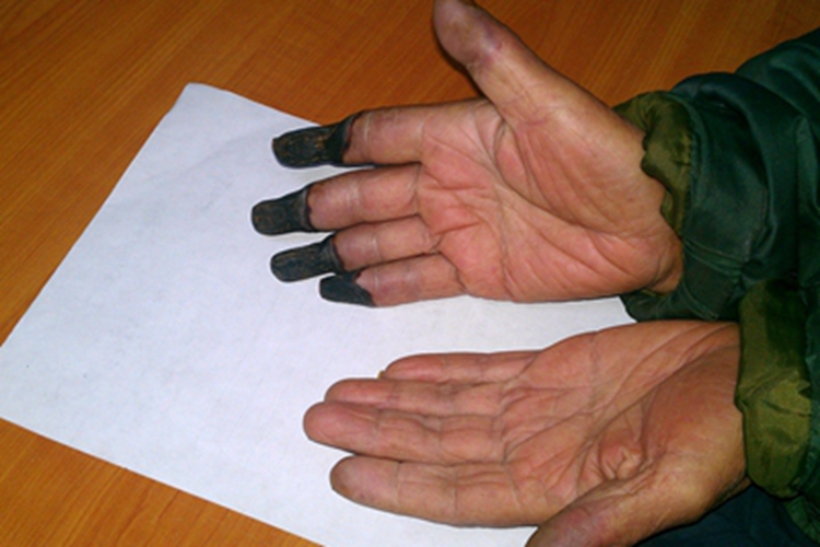 雷诺病指端发黑腐烂图 雷诺病指端发黑腐烂图